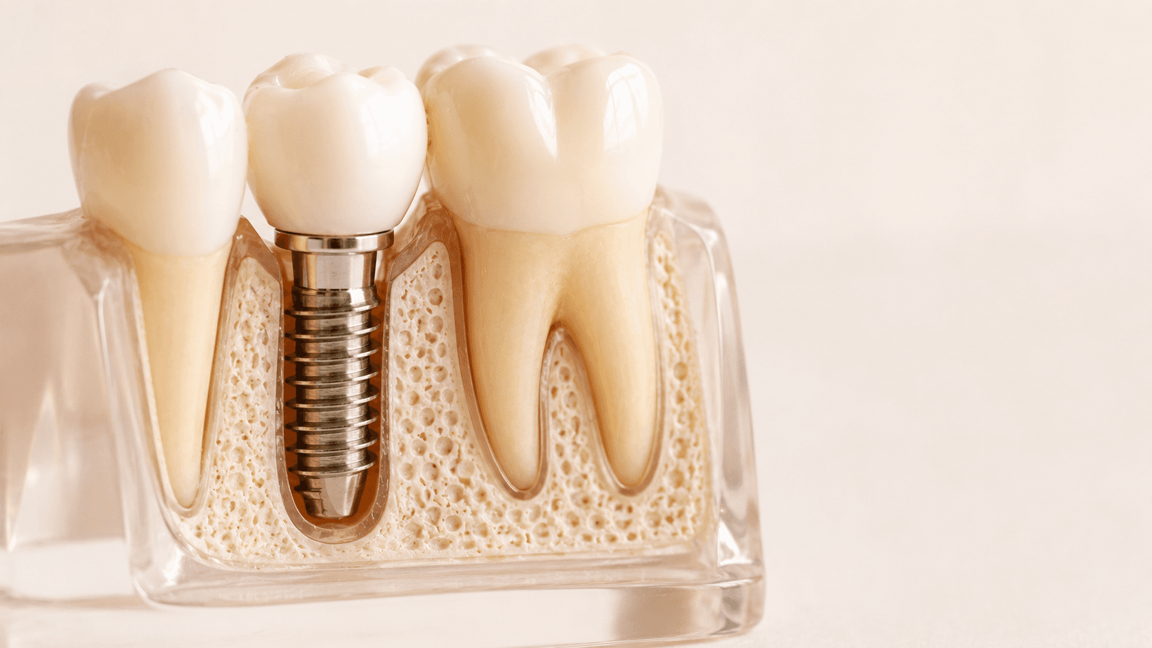 Implantes múltiples